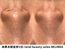 ベリンダ(BELINDA)/毛穴洗浄×セルマンピーリング