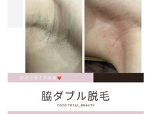 ココ平塚店(COCO)/人気のミックス脱毛