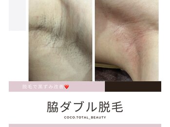 ココ平塚店(COCO)/人気のミックス脱毛