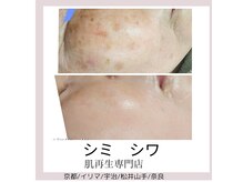 イリマ(Ilima)の雰囲気（様々なテストをクリアした完全国産の成長因子　修復機能　GFT）