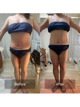 キアラ(Chiara)/痩身マシーン・ビフォーアフター