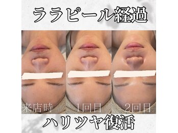 ホワイトアクア 中目黒店(WHITE AQUA)/ララピール/毛穴/美白/中目黒