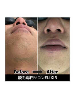 エリクサー 太田店(Elixir)/before after