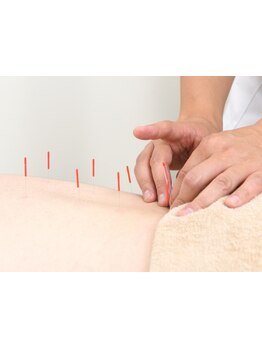 鍼灸施術を受けたい