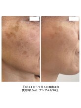 エミット(emit.)/幹細胞エクソソーム導入