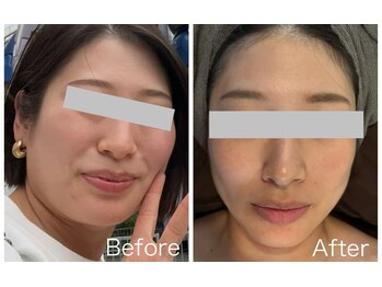 なごみ/小顔◆脂肪分解液レッドショット