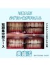 【人気NO.1！！フリーパス】美白ホワイトニング20分×20回￥44,000/西尾