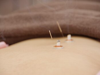 たかみや鍼灸接骨院の写真/花粉に悩むあなたへ、当院の鍼灸施術がオススメです◎心身のバランスを整え、快適な毎日をサポートします◎