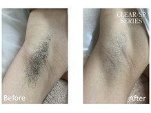 アットイカウ 下北沢(at ikaw)/ワキ脱毛 Before/After 