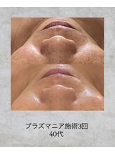 コンクパール(CONCH PEARL.)/プラズマニア