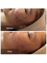 リリアン(Re:lien)/ハーブピーリング