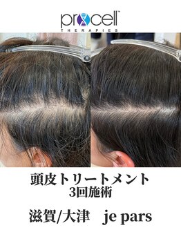 ジュパール(je pars)/プロセル頭皮トリートメント