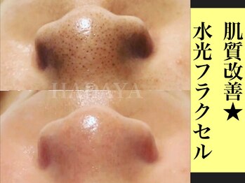 肌屋(HADA-YA)/水光セルで黒ずみ改善!!