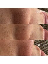 ウミ(Ummi)/毛穴エクストラクション