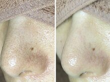 美鼻ラボ 押上 曳舟/毛穴ケアをする前とした後の比較