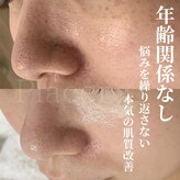 プラセル(Placer)