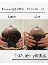 エレミュー(Elemue)/立体感をつくる小顔術