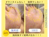 【お顔の脂肪・たるみの徹底改善！】レモンボトル（2ｃｃ）×リフトUPコース