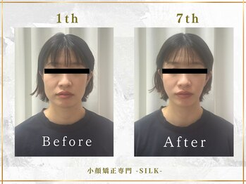 シルク(SILK)の写真/【高リピート率・口コミ高評価】エラ張り・左右差・たるみ改善に専門特化◎食いしばり改善・小顔効果抜群◎