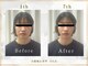 シルク(SILK)の写真/【高リピート率・口コミ高評価】エラ張り・左右差・たるみ改善に専門特化◎食いしばり改善・小顔効果抜群◎