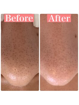 ミーサ(Mysarest)/いちご鼻もフェイスワックス！！