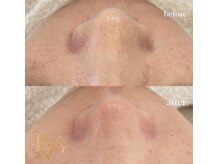 ラヴィス(RAVIS)/圧倒的効果！ツヤ肌ぴかぴか♪