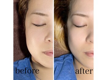 ルーブル ビュー(Louvre be)/スッキリフェイスライン♪