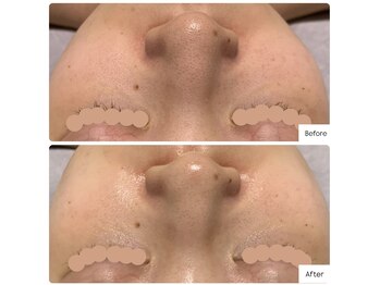 ラグ(LUXU)/毛穴の黒ずみにも◎