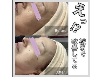 じゅえる/シミケアとシワたるみケア次へ→