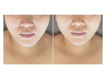 サプナジー(Suppnrgy)/クレンズコルギ1回