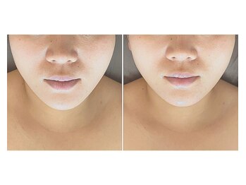 サプナジー(Suppnrgy)/クレンズコルギ1回