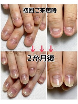 ¥11000 深爪矯正コース