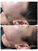 ル クラージュ(Le courage)/バクテリウムピール(20代男性)