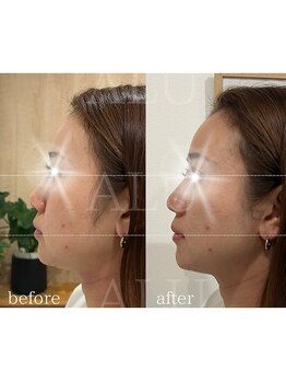 アルフォービューティー 難波店(ALU for beauty)/オンダリフト症例