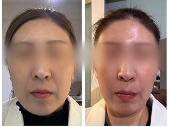 ワイスリー(Y3)/小顔リフトアップ