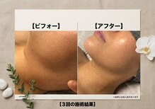リボーン(RE BORN)