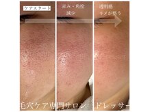 ドレッサー(Dresser)の雰囲気（美容サロンでなかなか改善できなかった凹凸毛穴の症例）