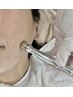 肌つやup【角質除去/水光美肌】ダイヤモンドピール＋LDM+冷却導入/小じわにも