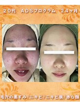 ナイア(naia)/リセラADS使用症例