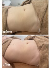 ラディアント(Radiant)/インディバ＆レモンボトル