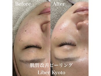 リベルキョウト 京都駅前店(Liber Kyoto)/肌質改善ピーリング