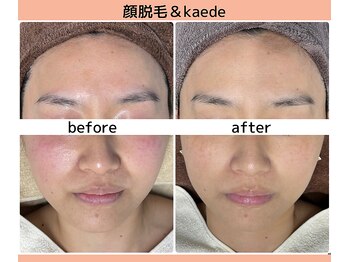 ベルミーランド 浜松天王/フェイシャルBefore→After