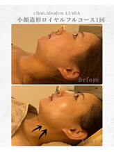 ルミア(LUMIA)/小顔造形ロイヤルフルコース１回