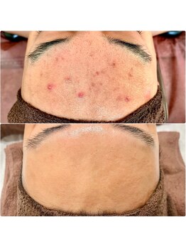 ヴィヴィエ 佐賀店(ViVier)の写真/【毛穴・ニキビ・くすみ肌質改善】剥離なしエクソソームハーブで憧れのツヤ肌へ♪