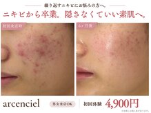 アルカンシエル(arcenciel)の雰囲気（【ニキビケアケア/シミケア/毛穴/ピーリング/ハーブピーリング】）
