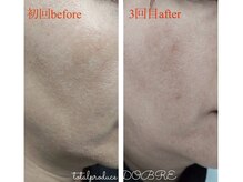 ドブレ(DOBRE)/【プラズマフェイシャル】