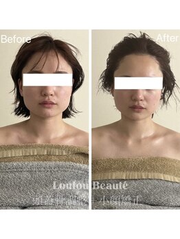 ルルボーテ(Loulou Beaute)/頭蓋骨調整+小顔矯正