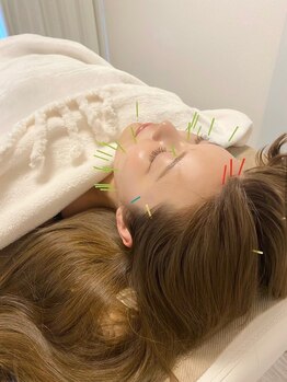 エテルニテ(eternite)/小顔・美肌集中 美容鍼コース