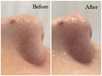 グラサヴォーグ 金沢店/長年悩みの黒ずみがキレイに