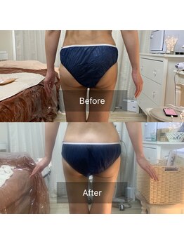 キアラ(Chiara)/痩身マシーン・ビフォーアフター